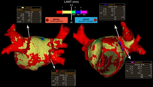Mappa 3D dello spessore della parete atriale sinistra (LAWT) con i valori di Ablation Index personalizzati punto per punto nell'ablazione della fibrillazione atriale